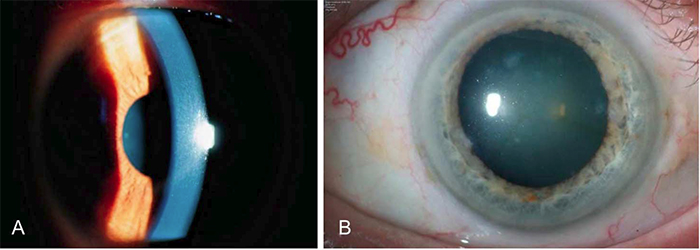 corneal dystrophies